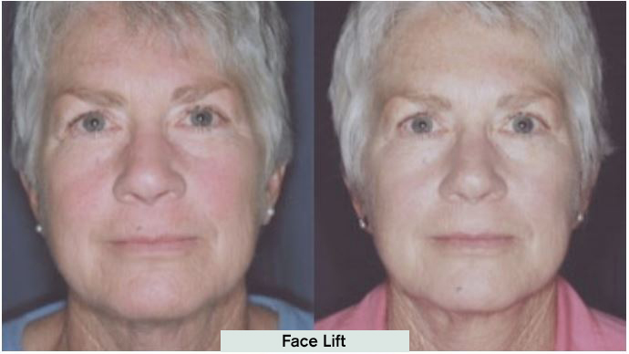 Face Lift Results