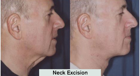 Neck Excision Results