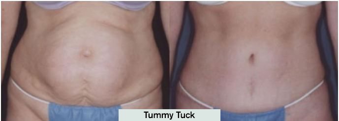 Tummy Tuck Results