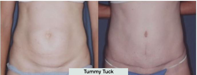 Tummy Tuck Results